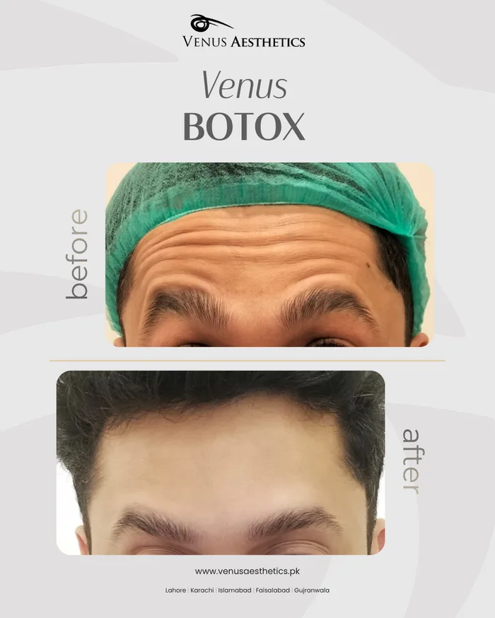 Botox treatment before and after photo of an actual Venus Aesthetics client, 1 of 2