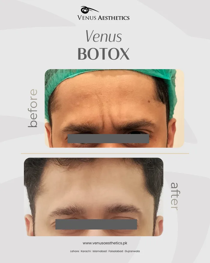 Botox treatment before and after photo of an actual Venus Aesthetics client, 2 of 2