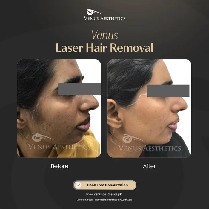 Laser hair removal before and after photo of an actual Venus Aesthetics client, 17 of 17