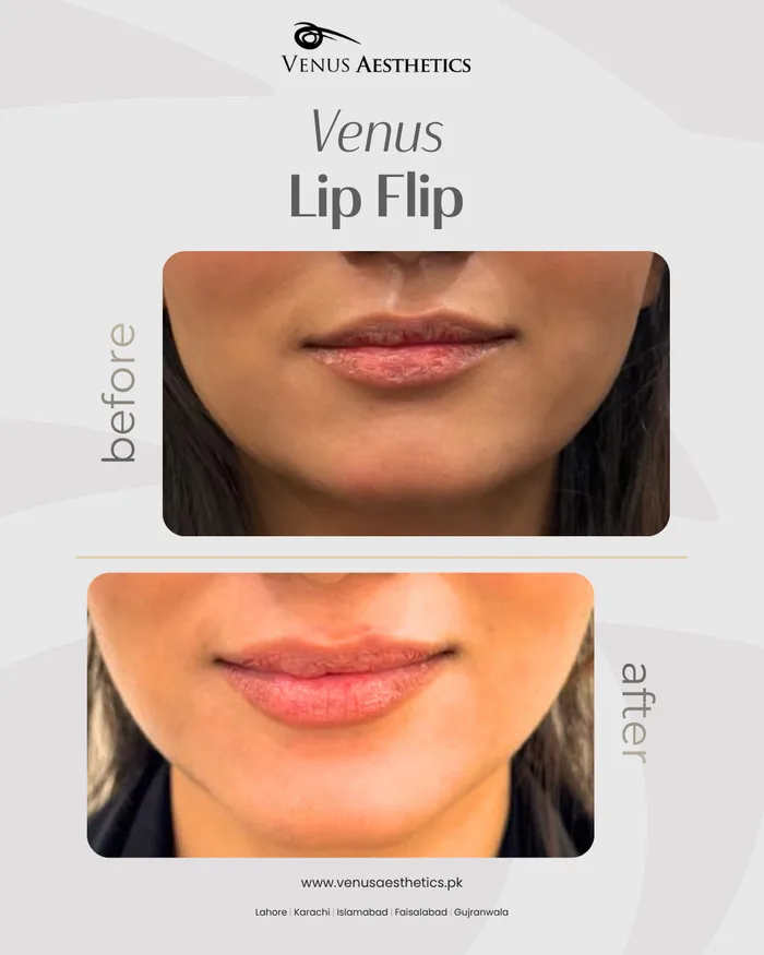 Botox lip flip before and after photo of an actual Venus Aesthetics client, 1 of 1