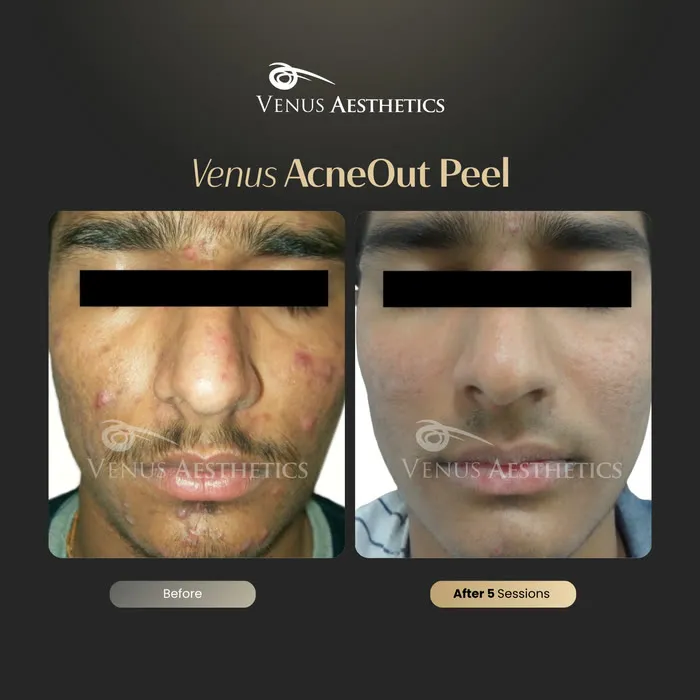 AcneOUT Peel for acne-prone skin before and after photo of an actual Venus Aesthetics client, 1 of 9