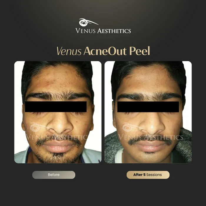 AcneOUT Peel for acne-prone skin before and after photo of an actual Venus Aesthetics client, 2 of 9