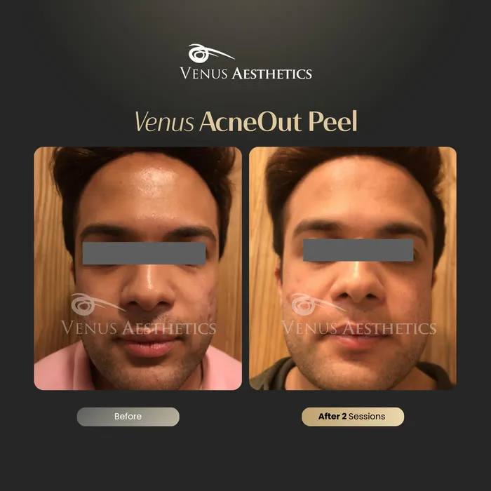 AcneOUT peel before and after result at Venus Aesthetics