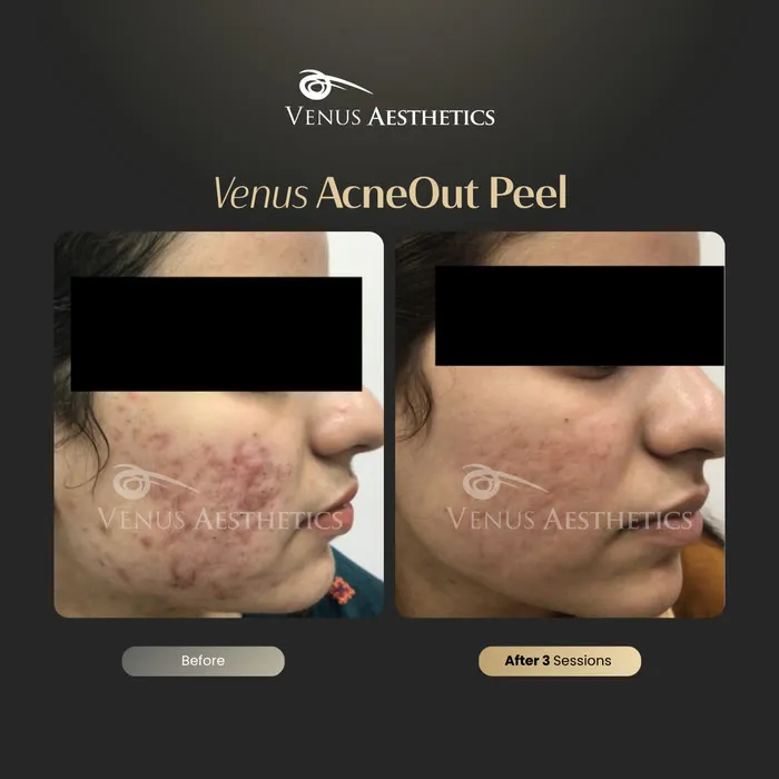 AcneOUT Peel for acne-prone skin before and after photo of an actual Venus Aesthetics client, 4 of 9