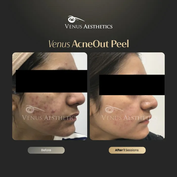 AcneOUT Peel for acne-prone skin before and after photo of an actual Venus Aesthetics client, 5 of 9
