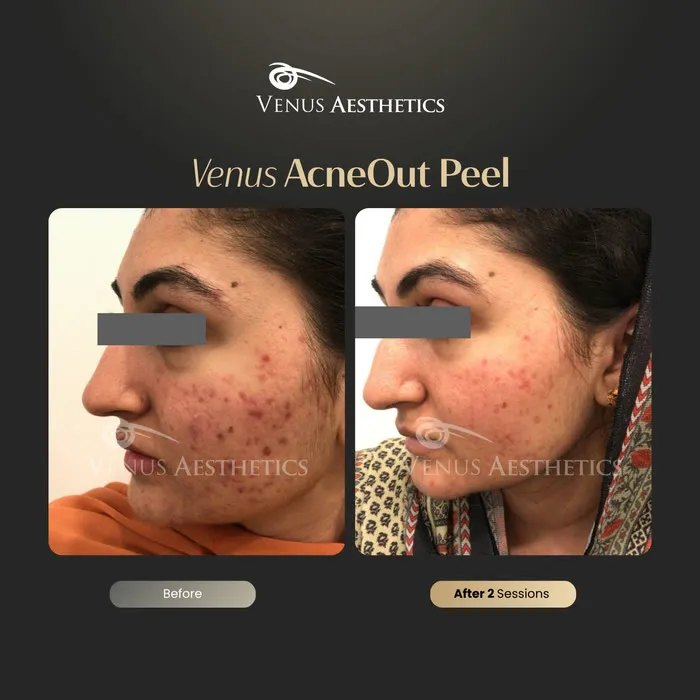 AcneOUT Peel for acne-prone skin before and after photo of an actual Venus Aesthetics client, 6 of 9