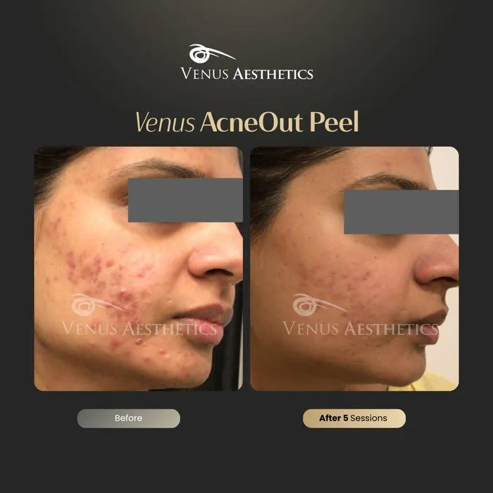 AcneOUT Peel for acne-prone skin before and after photo of an actual Venus Aesthetics client, 7 of 9