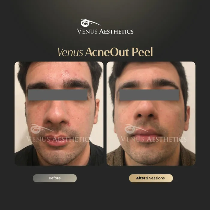 AcneOUT Peel for acne-prone skin before and after photo of an actual Venus Aesthetics client, 8 of 9