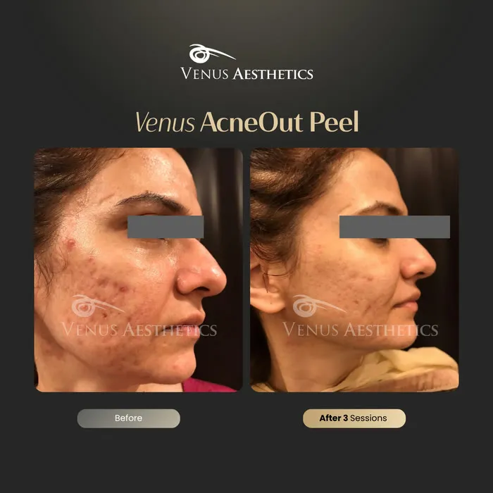 AcneOUT Peel for acne-prone skin before and after photo of an actual Venus Aesthetics client, 9 of 9
