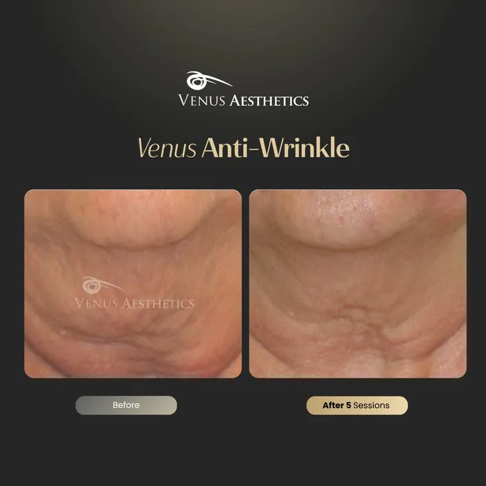 Venus Anti-Wrinkle Treatment before and after photo of an actual Venus Aesthetics client, 1 of 3