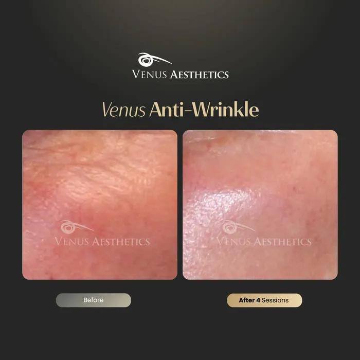 Venus Anti-Wrinkle Treatment before and after photo of an actual Venus Aesthetics client, 2 of 3