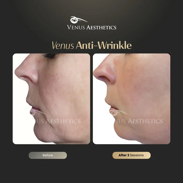 Venus Anti-Wrinkle Treatment before and after photo of an actual Venus Aesthetics client, 3 of 3