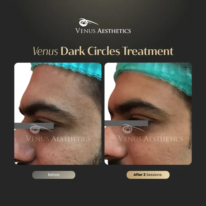 Dark circle treatment under the eyes before and after photo of an actual Venus Aesthetics client, 1 of 4
