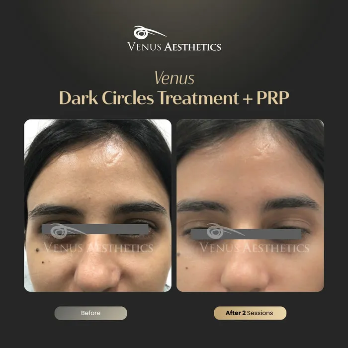 Dark circle treatment under the eyes before and after photo of an actual Venus Aesthetics client, 2 of 4