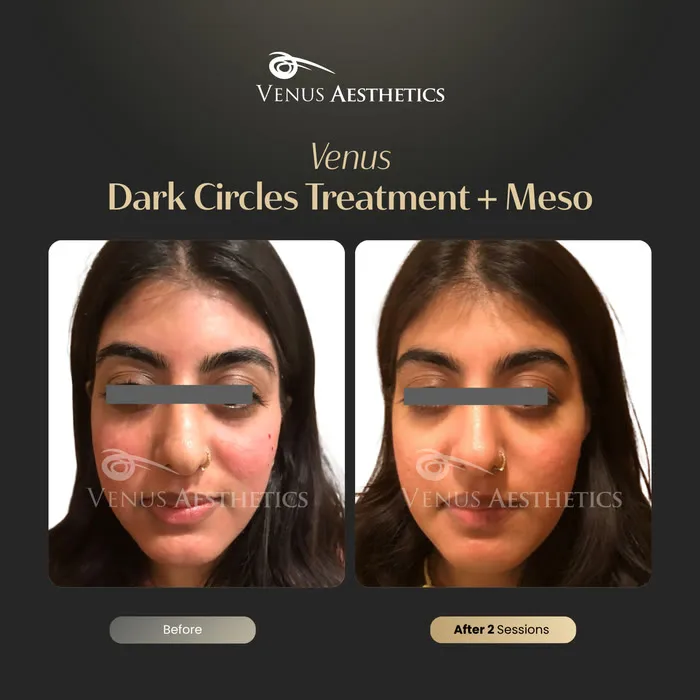 Dark circle treatment under the eyes before and after photo of an actual Venus Aesthetics client, 3 of 4