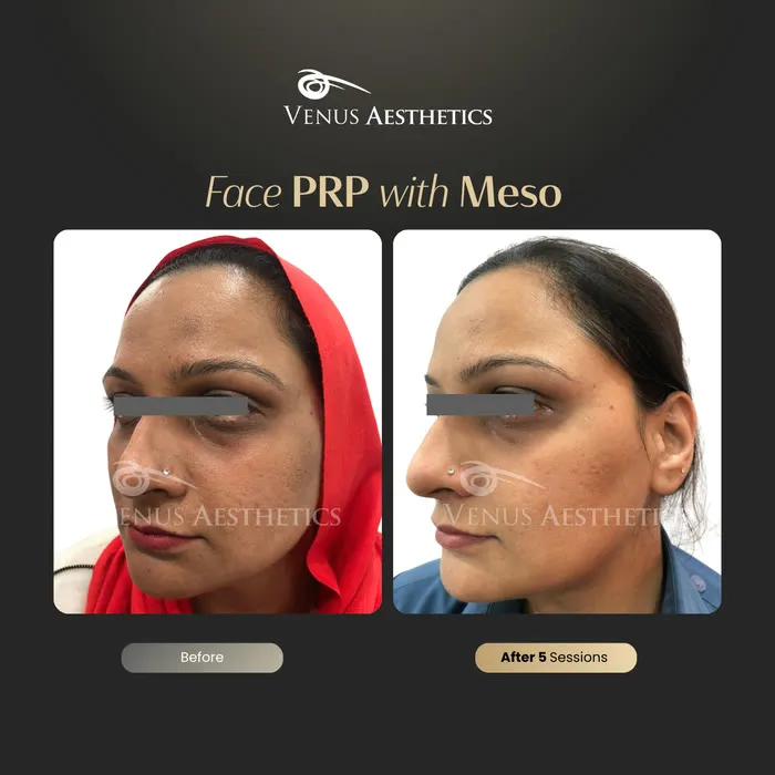 Dark circle treatment under the eyes before and after photo of an actual Venus Aesthetics client, 4 of 4