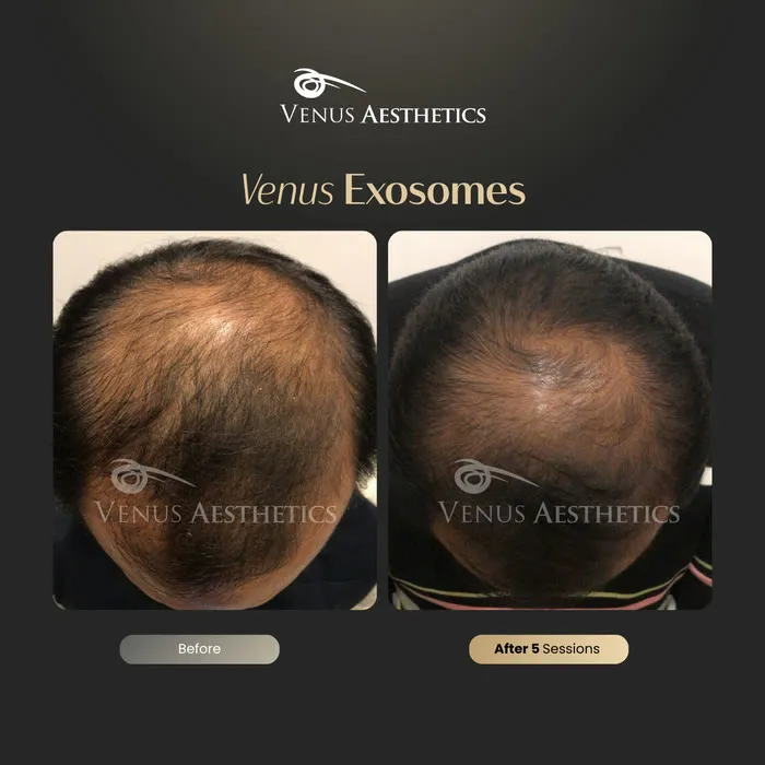 Exosome hair therapy before and after result at Venus Aesthetics