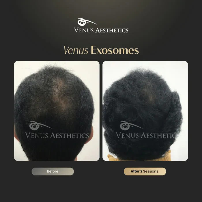 Exosomes for Hair treatment before and after photo of an actual Venus Aesthetics client, 2 of 4