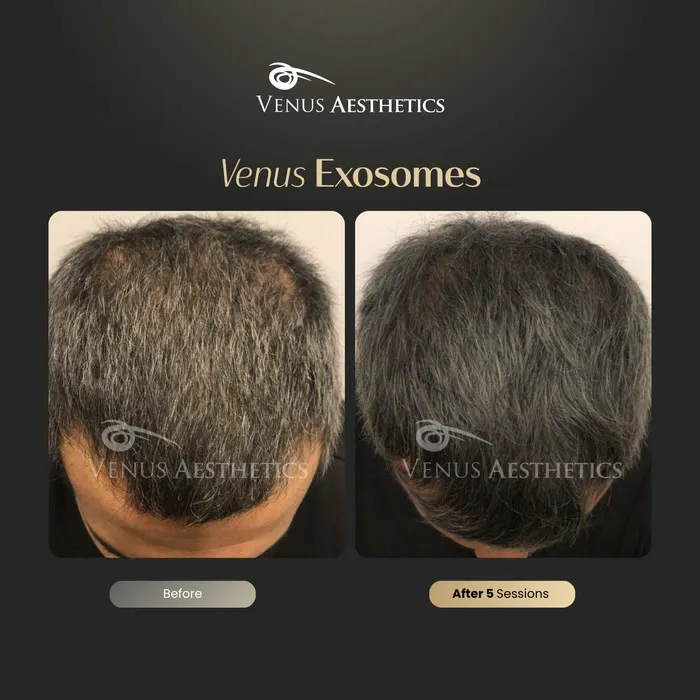 Exosomes for Hair treatment before and after photo of an actual Venus Aesthetics client, 3 of 4