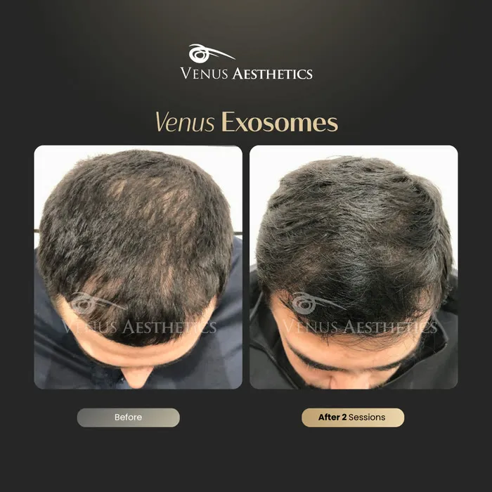 Exosomes for Hair treatment before and after photo of an actual Venus Aesthetics client, 4 of 4