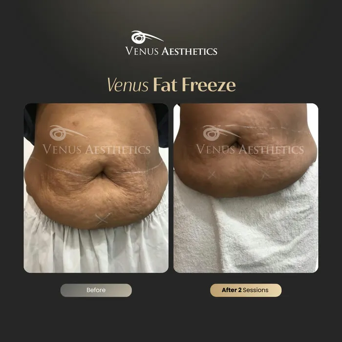Venus FatFree before and after result at Venus Aesthetics