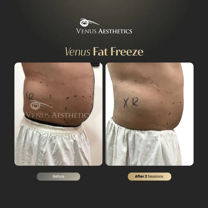 Venus FatFree before and after result at Venus Aesthetics