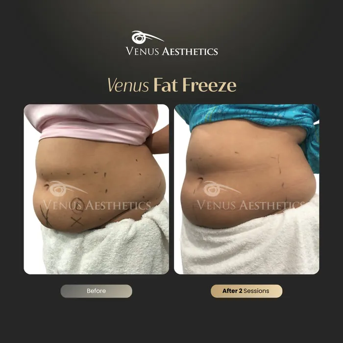 Fat freezing body contouring before and after photo of an actual Venus Aesthetics client, 3 of 8