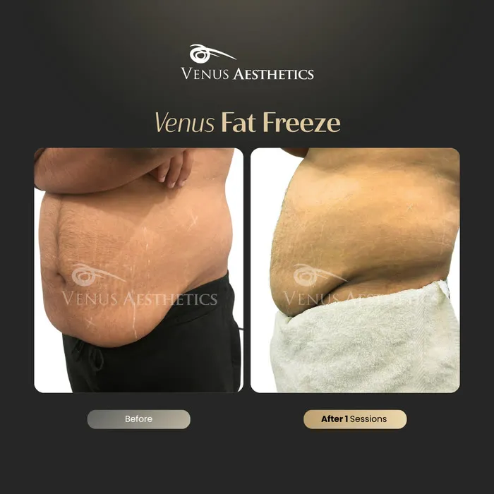 Fat freezing body contouring before and after photo of an actual Venus Aesthetics client, 4 of 8