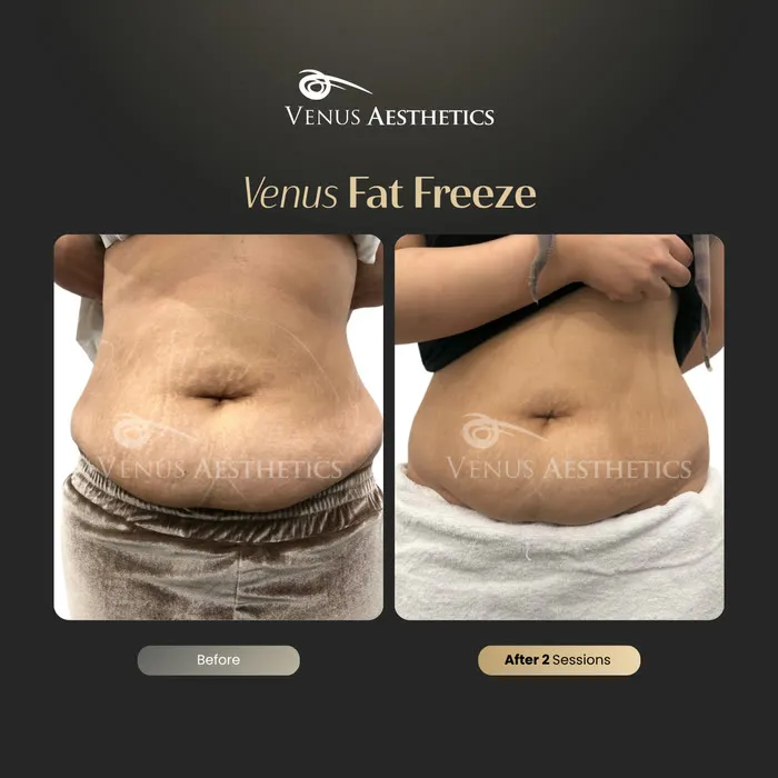 Fat freezing body contouring before and after photo of an actual Venus Aesthetics client, 5 of 8