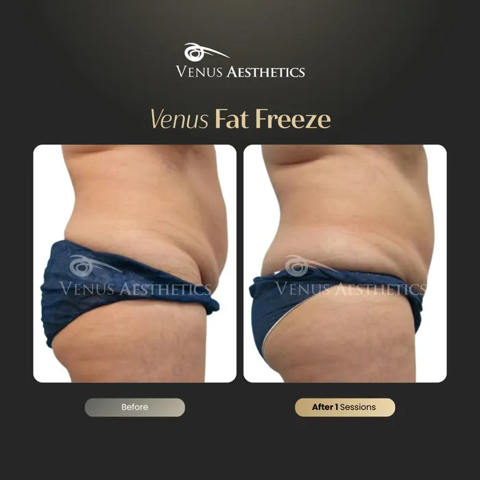 Fat freezing body contouring before and after photo of an actual Venus Aesthetics client, 6 of 8