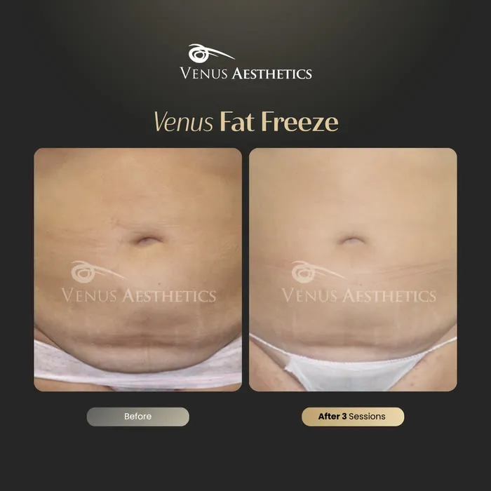 Venus FatFree before and after result at Venus Aesthetics