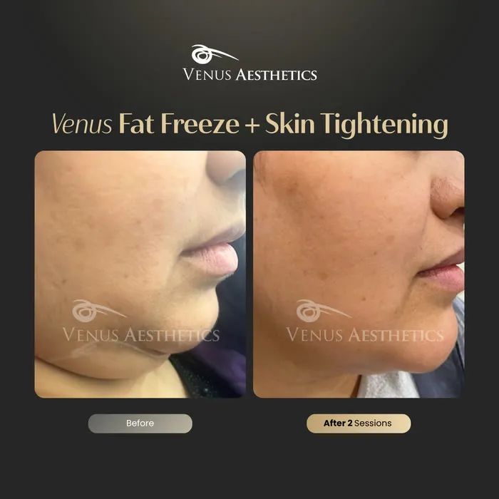 Venus FatFree before and after result at Venus Aesthetics