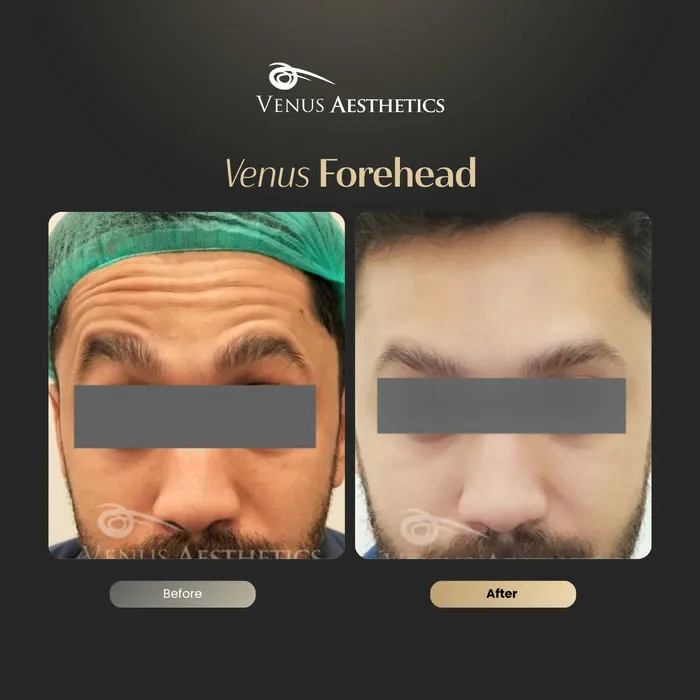 Forehead line Botox before and after result at Venus Aesthetics