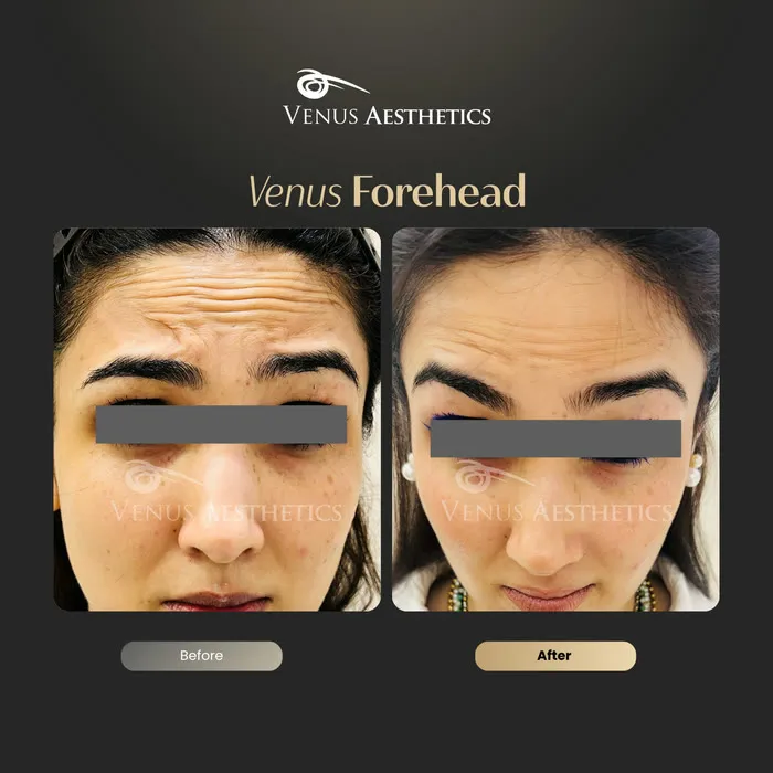 Botox for forehead lines before and after photo of an actual Venus Aesthetics client, 2 of 7