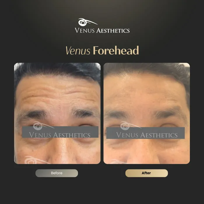 Botox for forehead lines before and after photo of an actual Venus Aesthetics client, 3 of 7