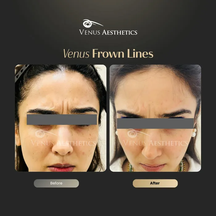 Botox before and after result at Venus Aesthetics