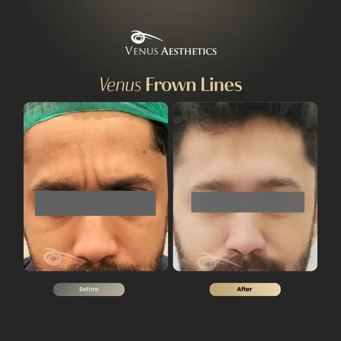 Botox before and after result at Venus Aesthetics