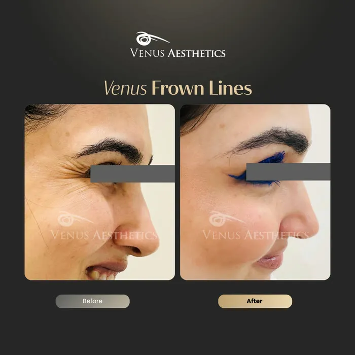 Botox before and after result at Venus Aesthetics
