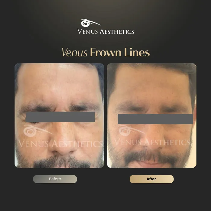 Botox for frown lines before and after photo of an actual Venus Aesthetics client, 7 of 7