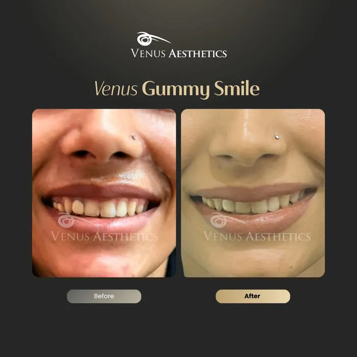 Botox for a gummy smile before and after photo of an actual Venus Aesthetics client, 1 of 2