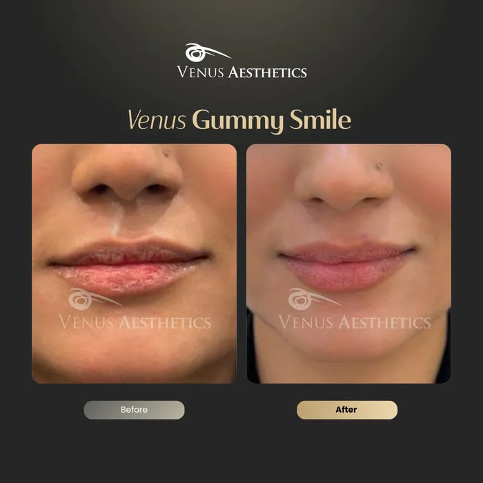 Gummy smile Botox before and after result at Venus Aesthetics