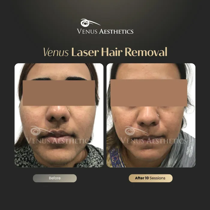Laser hair removal before and after photo of an actual Venus Aesthetics client, 1 of 17