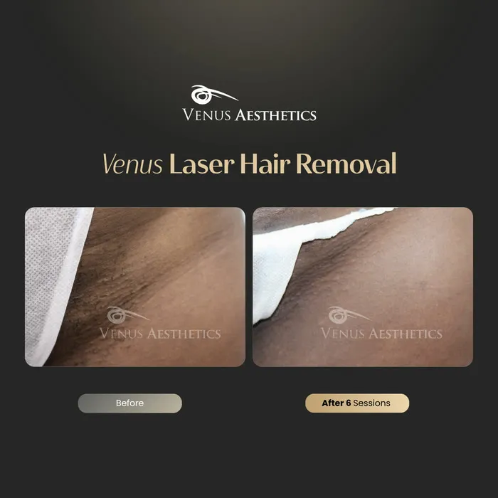 Laser hair removal before and after result at Venus Aesthetics