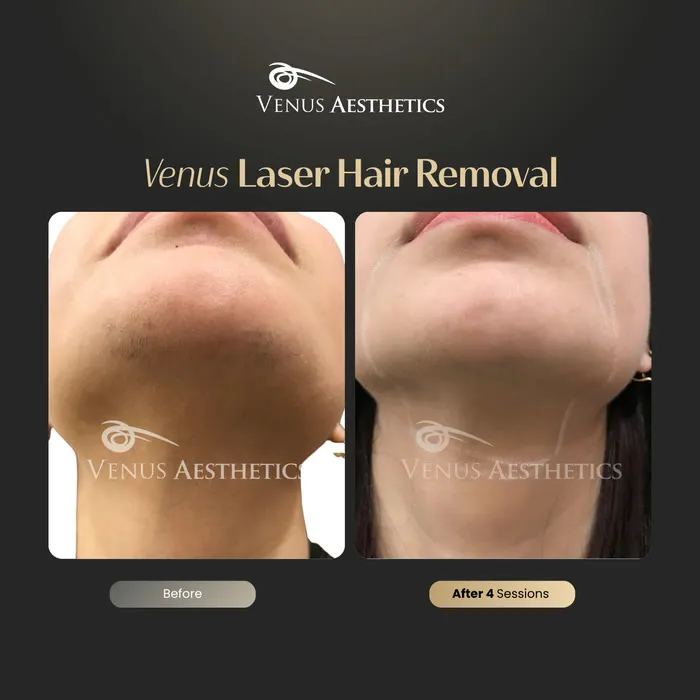 Laser hair removal before and after result at Venus Aesthetics