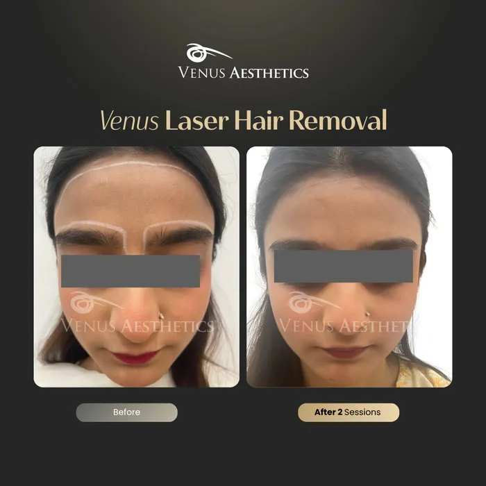 Laser hair removal before and after photo of an actual Venus Aesthetics client, 12 of 17
