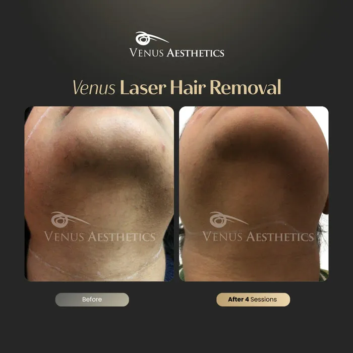 Laser hair removal before and after result at Venus Aesthetics