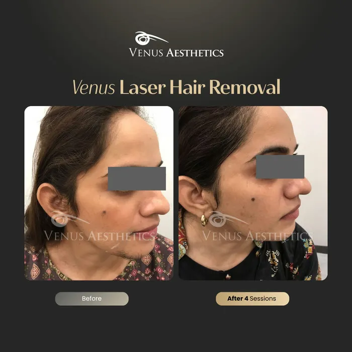 Laser hair removal before and after photo of an actual Venus Aesthetics client, 14 of 17