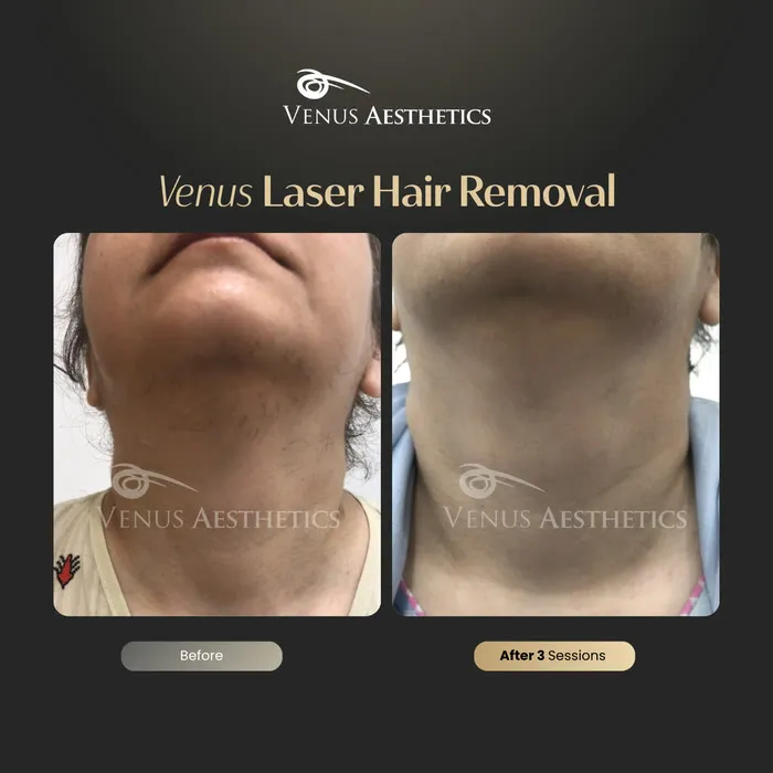 Laser hair removal before and after photo of an actual Venus Aesthetics client, 15 of 17