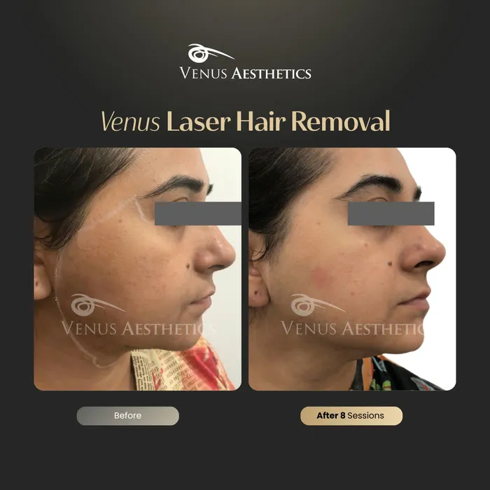 Laser hair removal before and after photo of an actual Venus Aesthetics client, 16 of 17
