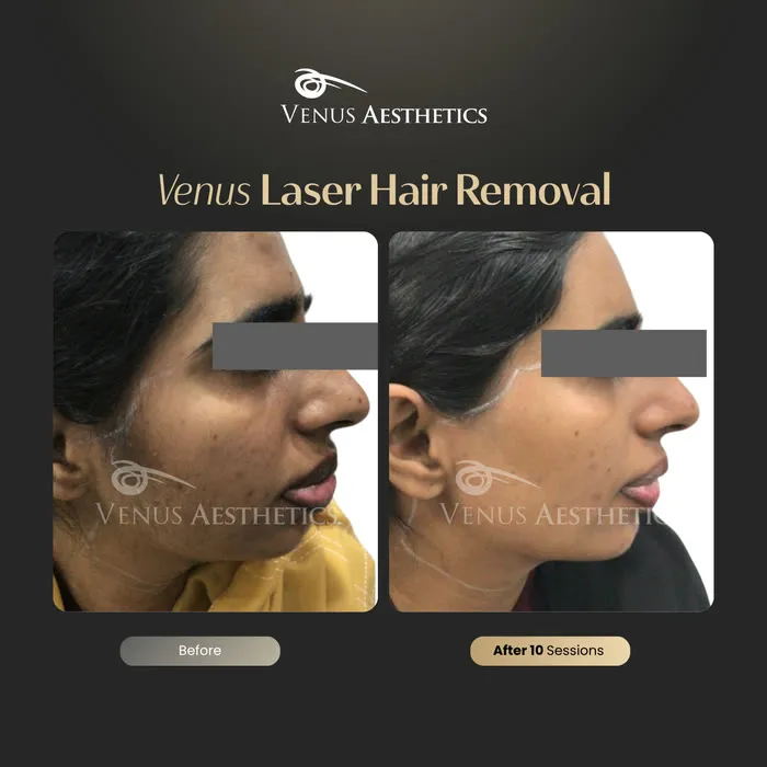 Laser hair removal before and after result at Venus Aesthetics
